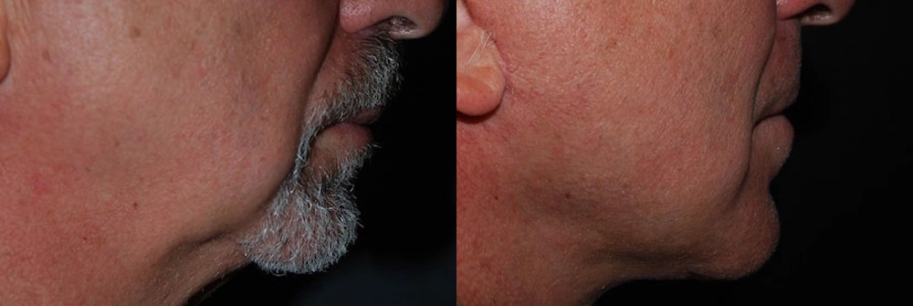 Real Patient Results in Newport Beach, CA. Preformed by Semira Bayait, MD, FACS.