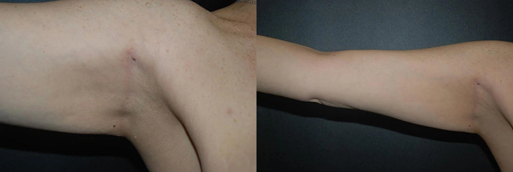 Real Patient Results in Newport Beach, CA. Preformed by Semira Bayait, MD, FACS.
