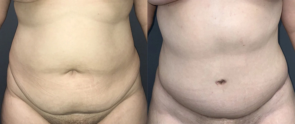 Real Patient Results in Newport Beach, CA. Preformed by Semira Bayait, MD, FACS.