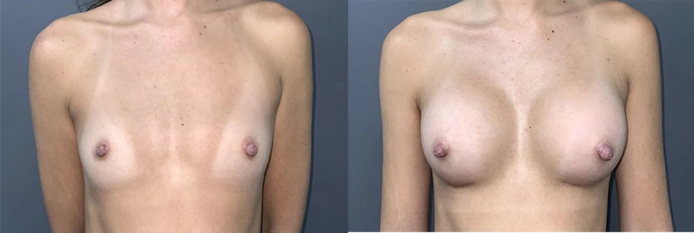 Real Patient Results in Newport Beach, CA. Preformed by Semira Bayait, MD, FACS.