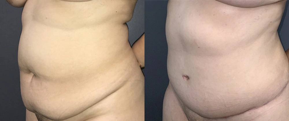 Real Patient Results in Newport Beach, CA. Preformed by Semira Bayait, MD, FACS.