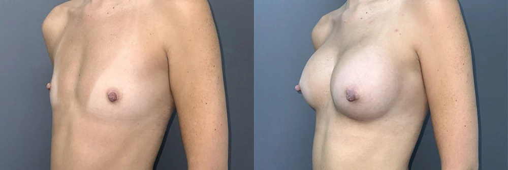 Real Patient Results in Newport Beach, CA. Preformed by Semira Bayait, MD, FACS.