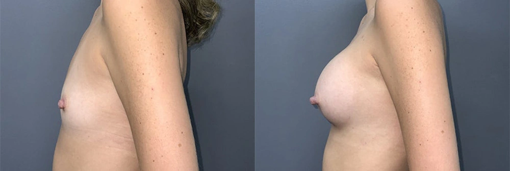 Real Patient Results in Newport Beach, CA. Preformed by Semira Bayait, MD, FACS.