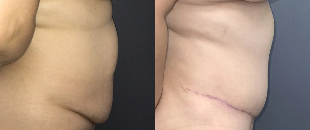 Real Patient Results in Newport Beach, CA. Preformed by Semira Bayait, MD, FACS.