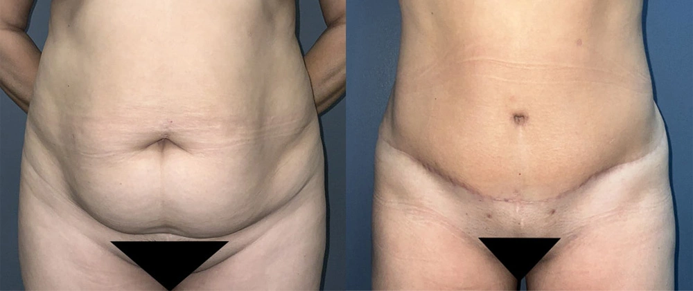 Real Patient Results in Newport Beach, CA. Preformed by Semira Bayait, MD, FACS.