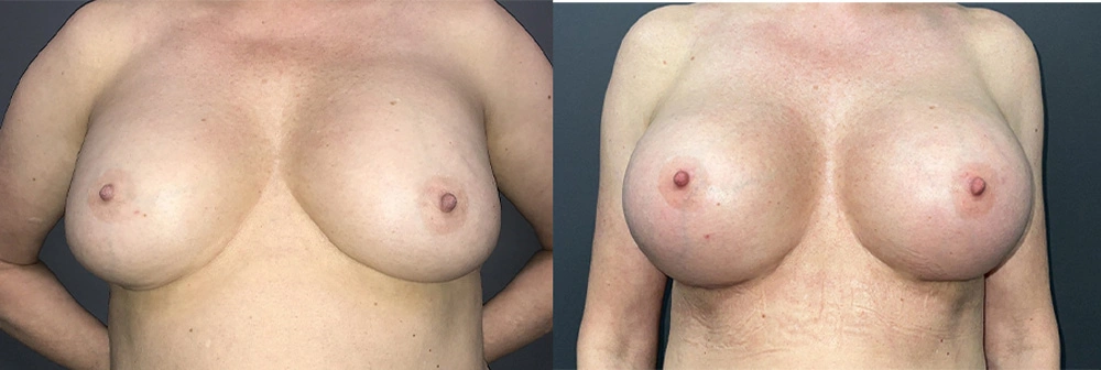 Real Patient Results in Newport Beach, CA. Preformed by Semira Bayait, MD, FACS.