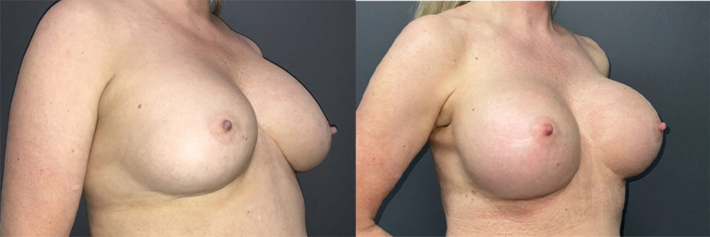 Real Patient Results in Newport Beach, CA. Preformed by Semira Bayait, MD, FACS.