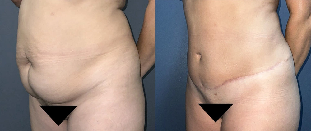 Real Patient Results in Newport Beach, CA. Preformed by Semira Bayait, MD, FACS.
