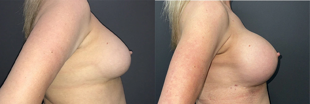 Real Patient Results in Newport Beach, CA. Preformed by Semira Bayait, MD, FACS.