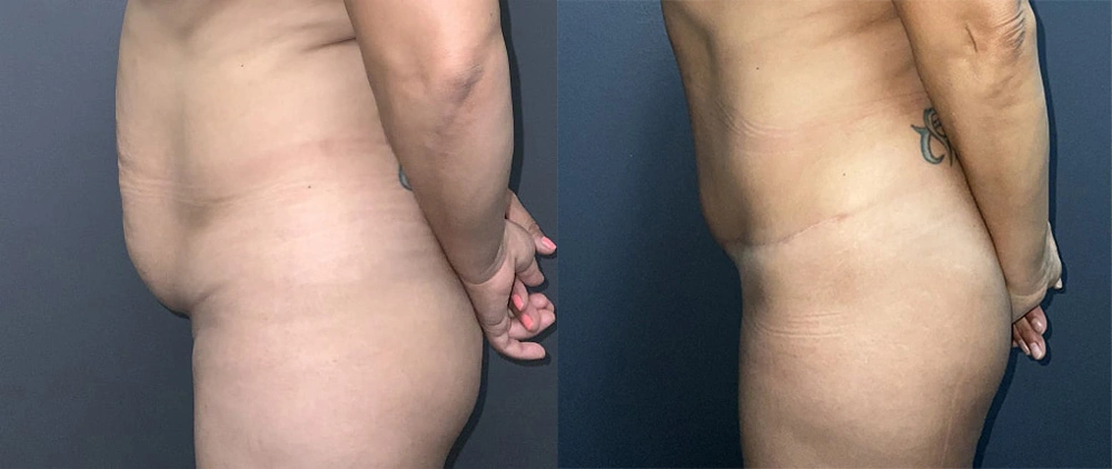 Real Patient Results in Newport Beach, CA. Preformed by Semira Bayait, MD, FACS.