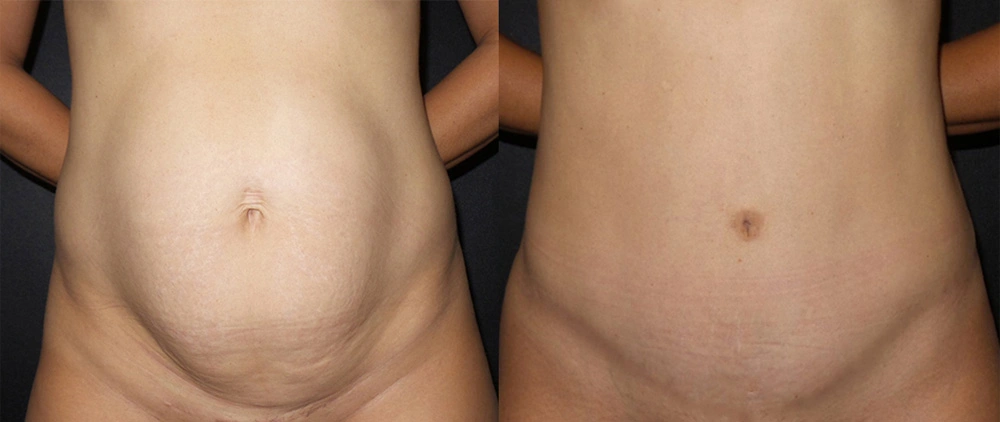 Real Patient Results in Newport Beach, CA. Preformed by Semira Bayait, MD, FACS.