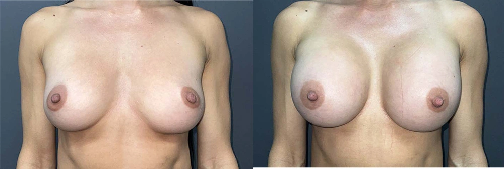 Real Patient Results in Newport Beach, CA. Preformed by Semira Bayait, MD, FACS.