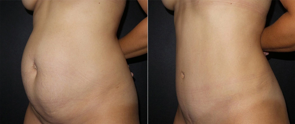 Real Patient Results in Newport Beach, CA. Preformed by Semira Bayait, MD, FACS.