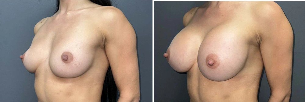 Real Patient Results in Newport Beach, CA. Preformed by Semira Bayait, MD, FACS.