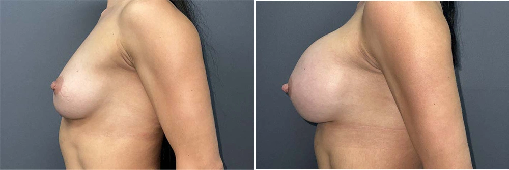 Real Patient Results in Newport Beach, CA. Preformed by Semira Bayait, MD, FACS.