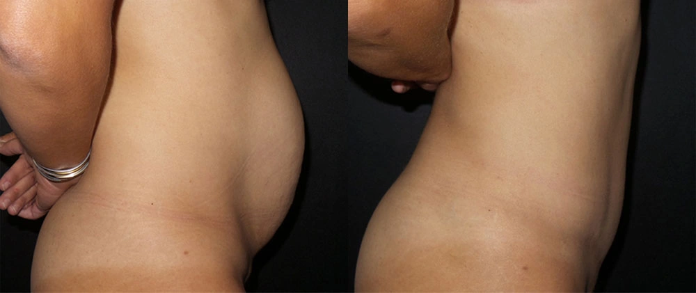 Real Patient Results in Newport Beach, CA. Preformed by Semira Bayait, MD, FACS.
