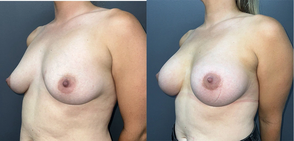 Real Patient Results in Newport Beach, CA. Preformed by Semira Bayait, MD, FACS.