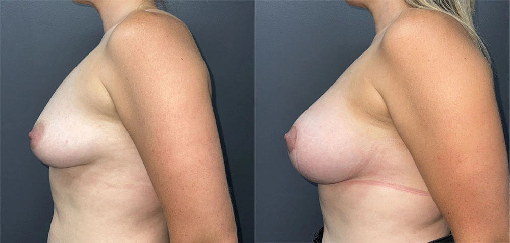 Real Patient Results in Newport Beach, CA. Preformed by Semira Bayait, MD, FACS.
