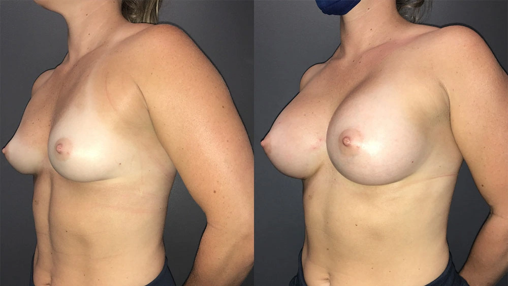Real Patient Results in Newport Beach, CA. Preformed by Semira Bayait, MD, FACS.