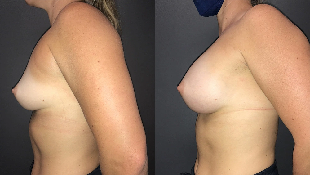 Real Patient Results in Newport Beach, CA. Preformed by Semira Bayait, MD, FACS.