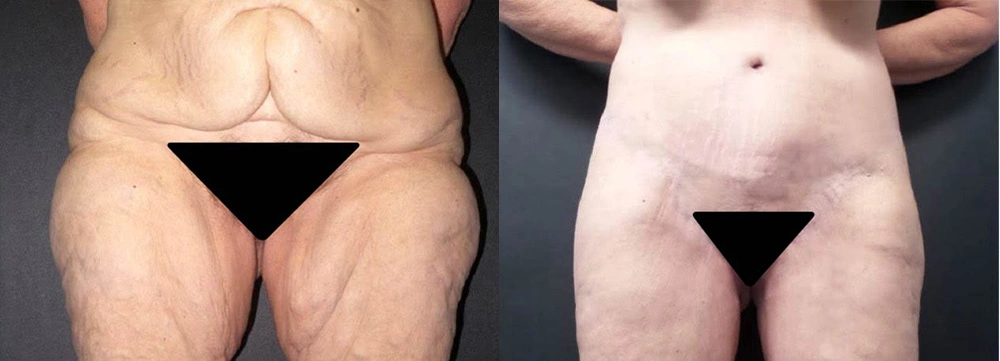 Real Patient Results in Newport Beach, CA. Preformed by Semira Bayait, MD, FACS.