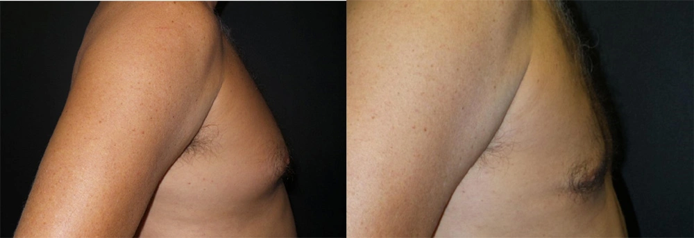 Real Patient Results in Newport Beach, CA. Preformed by Semira Bayait, MD, FACS.