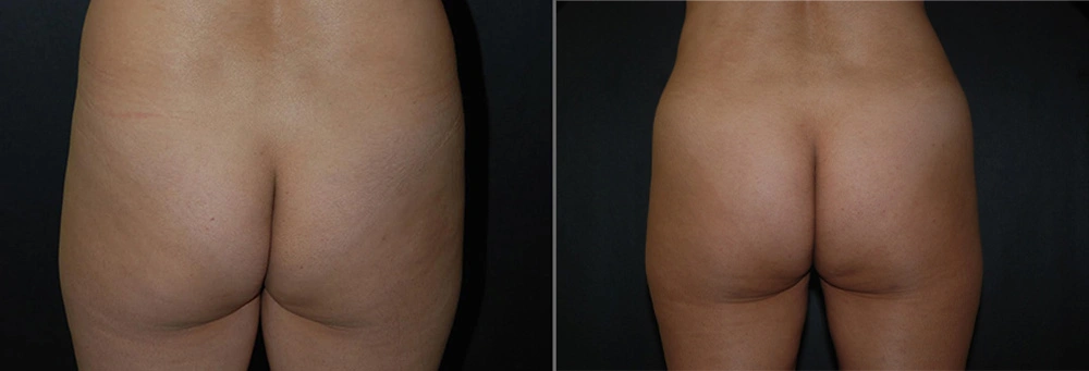 Real Patient Results in Newport Beach, CA. Preformed by Semira Bayait, MD, FACS.