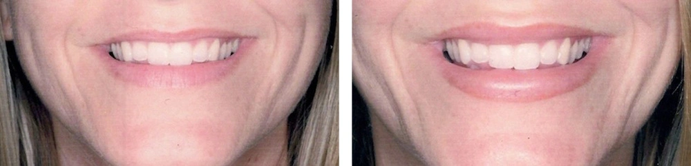 Real Patient Results in Newport Beach, CA. Preformed by Semira Bayait, MD, FACS.