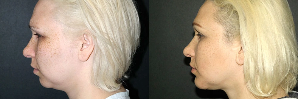 Real Patient Results in Newport Beach, CA. Preformed by Semira Bayait, MD, FACS.