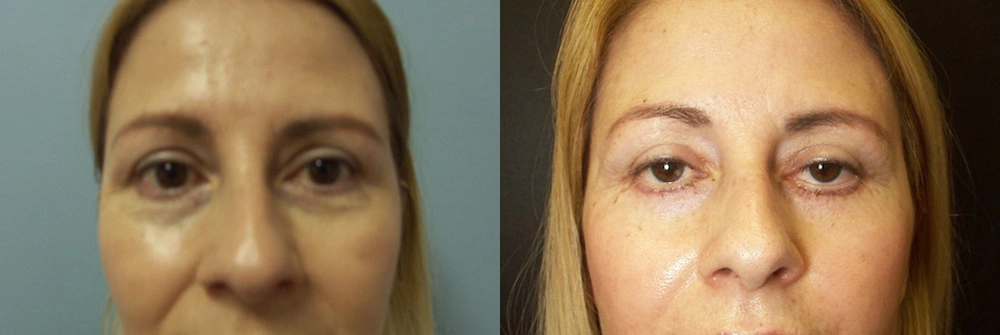 Real Patient Results in Newport Beach, CA. Preformed by Semira Bayait, MD, FACS.