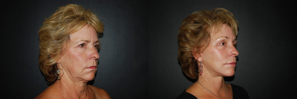 Real Patient Results in Newport Beach, CA. Preformed by Semira Bayait, MD, FACS.