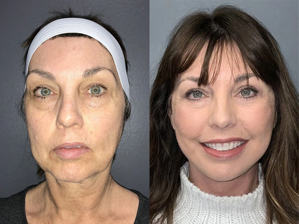 Real Patient Results in Newport Beach, CA. Preformed by Semira Bayait, MD, FACS.