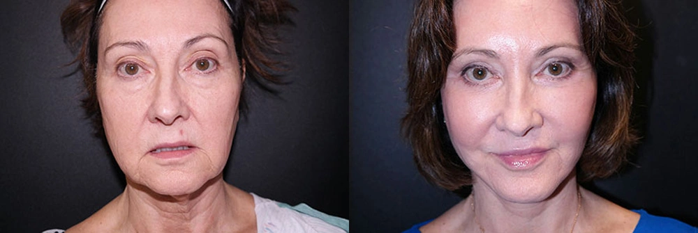 Real Patient Results in Newport Beach, CA. Preformed by Semira Bayait, MD, FACS.