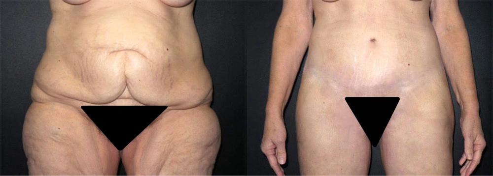 Real Patient Results in Newport Beach, CA. Preformed by Semira Bayait, MD, FACS.