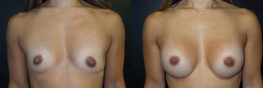 Real Patient Results in Newport Beach, CA. Preformed by Semira Bayait, MD, FACS.