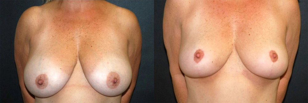 Real Patient Results in Newport Beach, CA. Preformed by Semira Bayait, MD, FACS.