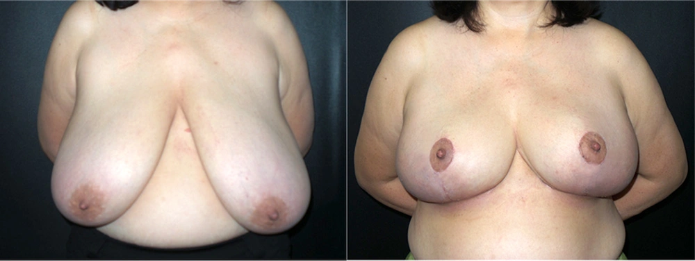 Real Patient Results in Newport Beach, CA. Preformed by Semira Bayait, MD, FACS.