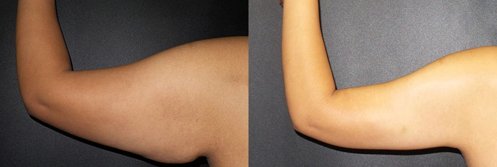 Real Patient Results in Newport Beach, CA. Preformed by Semira Bayait, MD, FACS.