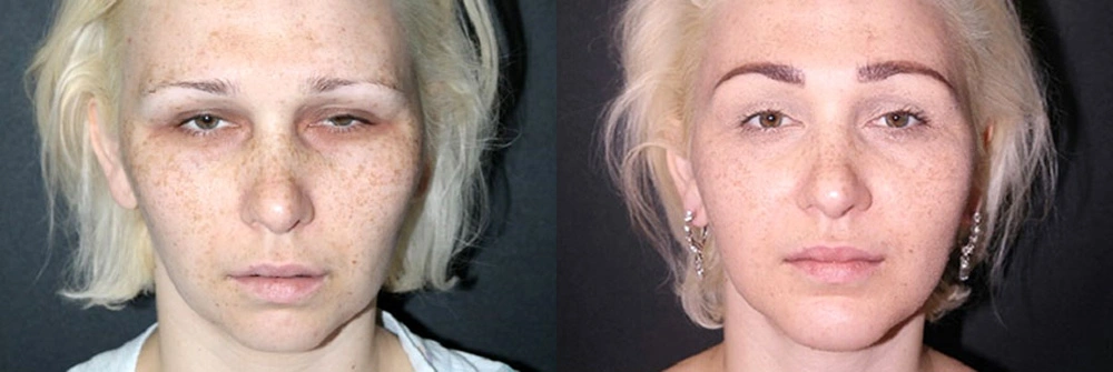 Real Patient Results in Newport Beach, CA. Preformed by Semira Bayait, MD, FACS.