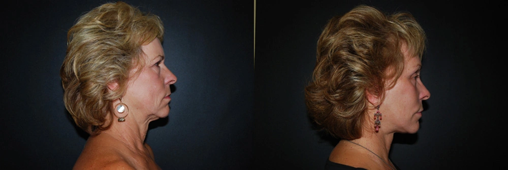 Real Patient Results in Newport Beach, CA. Preformed by Semira Bayait, MD, FACS.