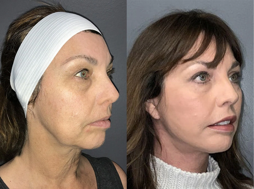 Real Patient Results in Newport Beach, CA. Preformed by Semira Bayait, MD, FACS.