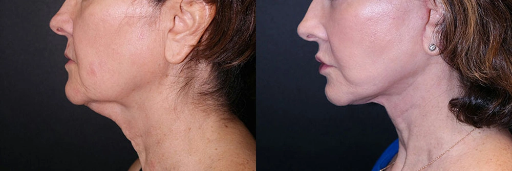 Real Patient Results in Newport Beach, CA. Preformed by Semira Bayait, MD, FACS.