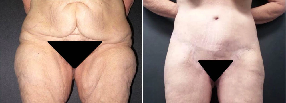 Real Patient Results in Newport Beach, CA. Preformed by Semira Bayait, MD, FACS.