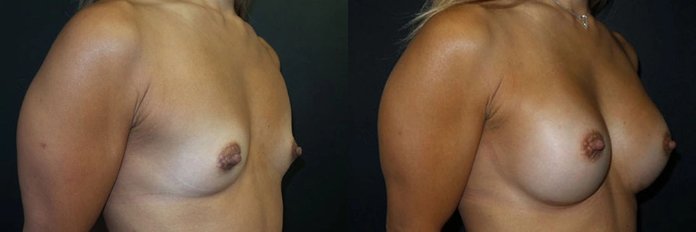 Real Patient Results in Newport Beach, CA. Preformed by Semira Bayait, MD, FACS.