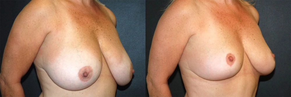 Real Patient Results in Newport Beach, CA. Preformed by Semira Bayait, MD, FACS.