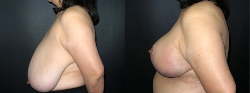 Real Patient Results in Newport Beach, CA. Preformed by Semira Bayait, MD, FACS.