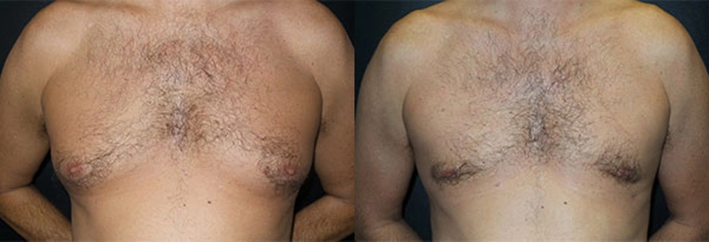 Real Patient Results in Newport Beach, CA. Preformed by Semira Bayait, MD, FACS.