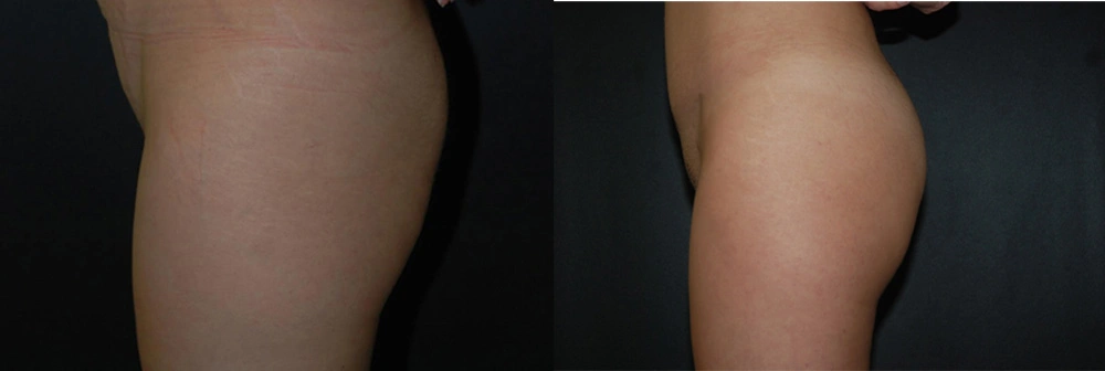 Real Patient Results in Newport Beach, CA. Preformed by Semira Bayait, MD, FACS.