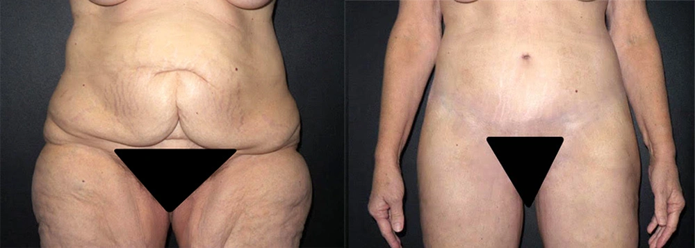 Real Patient Results in Newport Beach, CA. Preformed by Semira Bayait, MD, FACS.