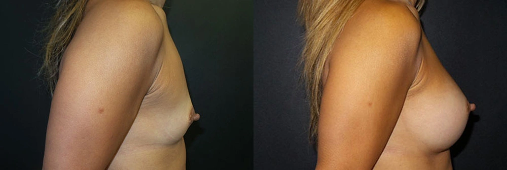 Real Patient Results in Newport Beach, CA. Preformed by Semira Bayait, MD, FACS.